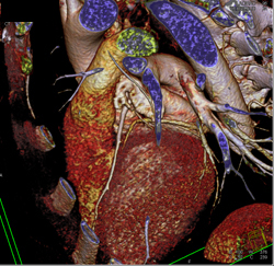 Dilated Origin of Reimplanted Right Coronary Artery (RCA) and Left Main Coronary Artery - CTisus CT Scan