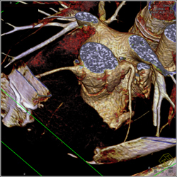 Dilated Origin of Reimplanted Right Coronary Artery (RCA) and Left Main Coronary Artery - CTisus CT Scan