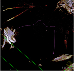 Dilated Origin of Reimplanted Right Coronary Artery (RCA) and Left Main Coronary Artery - CTisus CT Scan