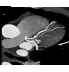 Plaque Left Anterior Descending Coronary Artery (LAD) Without Stenosis - CTisus CT Scan