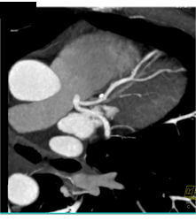 Plaque Left Anterior Descending Coronary Artery (LAD) Without Stenosis - CTisus CT Scan