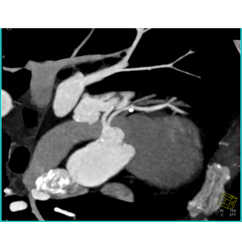 Plaque Left Anterior Descending Coronary Artery (LAD) Without Stenosis - CTisus CT Scan