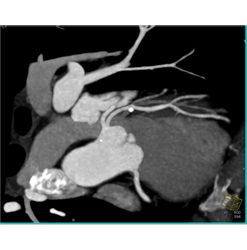 Plaque Left Anterior Descending Coronary Artery (LAD) Without Stenosis - CTisus CT Scan