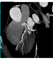 Plaque Left Anterior Descending Coronary Artery (LAD) Without Stenosis - CTisus CT Scan