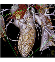 Plaque Left Anterior Descending Coronary Artery (LAD) Without Stenosis - CTisus CT Scan