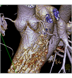 Plaque Left Anterior Descending Coronary Artery (LAD) Without Stenosis - CTisus CT Scan