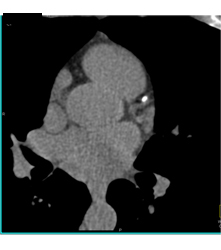 Plaque Left Anterior Descending Coronary Artery (LAD) Without Stenosis - CTisus CT Scan