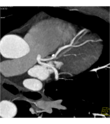 Plaque Left Anterior Descending Coronary Artery (LAD) Without Stenosis - CTisus CT Scan