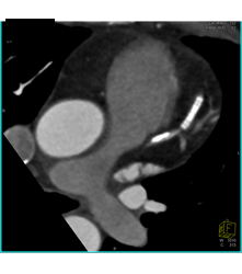 Stent in Left Anterior Descending Coronary Artery (LAD) and Plaque Proximal to Stent - CTisus CT Scan