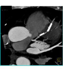 Stent in Left Anterior Descending Coronary Artery (LAD) and Plaque Proximal to Stent - CTisus CT Scan