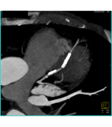 Stent in Left Anterior Descending Coronary Artery (LAD) and Plaque ...