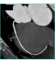 Stent in Left Anterior Descending Coronary Artery (LAD) and Plaque Proximal to Stent - CTisus CT Scan