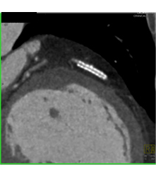 Stent in Left Anterior Descending Coronary Artery (LAD) and Plaque ...