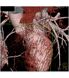 Stent in Left Anterior Descending Coronary Artery (LAD) and Plaque Proximal to Stent - CTisus CT Scan