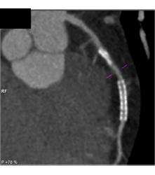 Stent in Left Anterior Descending Coronary Artery (LAD) and Plaque ...