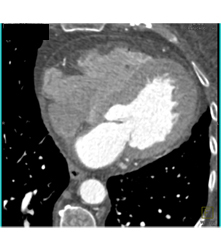 Fat in Wall of Right Ventricle - CTisus CT Scan