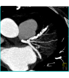 Extensive Plaque Left Anterior Descending Coronary Artery (LAD) - CTisus CT Scan