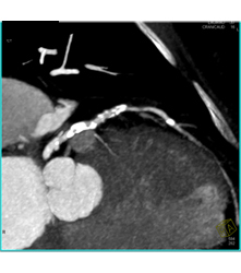 Extensive Plaque Left Anterior Descending Coronary Artery (LAD) - CTisus CT Scan