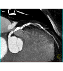 Extensive Plaque Left Anterior Descending Coronary Artery (LAD) - CTisus CT Scan