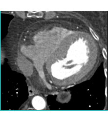 Fat in Wall of Right Ventricle - CTisus CT Scan