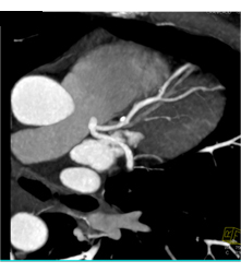 Left Anterior Descending Coronary Artery (LAD) Plaque Without Stenosis - CTisus CT Scan