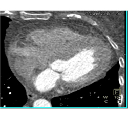 Fat in Wall of Right Ventricle - CTisus CT Scan