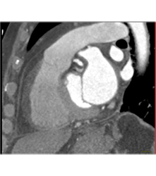 Fat in Wall of Right Ventricle - CTisus CT Scan