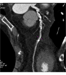 Left Anterior Descending Coronary Artery (LAD) Disease - CTisus CT Scan