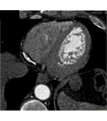 Multiple Plaques in RCA With Less Than 50% Stenosis in Select Zones and Greater Than 70% in Distal RCA - CTisus CT Scan