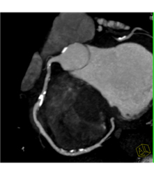 Multiple Plaques in RCA With Less Than 50% Stenosis in Select Zones and Greater Than 70% in Distal RCA - CTisus CT Scan