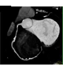 Multiple Plaques in RCA With Less Than 50% Stenosis in Select Zones and Greater Than 70% in Distal RCA - CTisus CT Scan