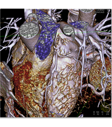 Multiple Plaques in RCA With Less Than 50% Stenosis in Select Zones and Greater Than 70% in Distal RCA - CTisus CT Scan