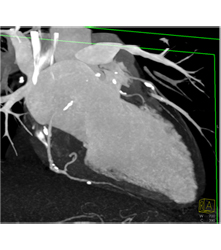 Multiple Plaques in RCA With Less Than 50% Stenosis in Select Zones and Greater Than 70% in Distal RCA - CTisus CT Scan