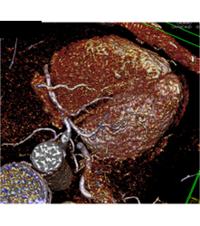 Multiple Plaques in RCA With Less Than 50% Stenosis in Select Zones and Greater Than 70% in Distal RCA - CTisus CT Scan