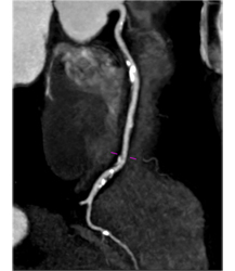 Multiple Plaques in RCA With Less Than 50% Stenosis in Select Zones and Greater Than 70% in Distal RCA - CTisus CT Scan