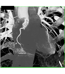 Multiple Plaques in RCA With Less Than 50% Stenosis in Select Zones and Greater Than 70% in Distal RCA - CTisus CT Scan