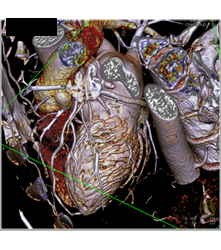 Multiple Plaques in RCA With Less Than 50% Stenosis in Select Zones and Greater Than 70% in Distal RCA - CTisus CT Scan