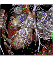 Multiple Plaques in RCA With Less Than 50% Stenosis in Select Zones and Greater Than 70% in Distal RCA - CTisus CT Scan