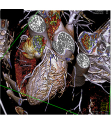 Multiple Plaques in RCA With Less Than 50% Stenosis in Select Zones and Greater Than 70% in Distal RCA - CTisus CT Scan