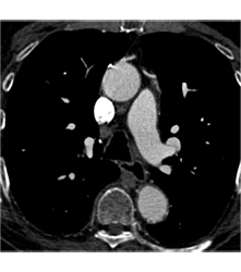 Left Internal Mammary Artery (LIMA) Graft and Venous Graft - CTisus CT Scan