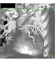 Left Internal Mammary Artery (LIMA) Graft and Venous Graft - CTisus CT Scan