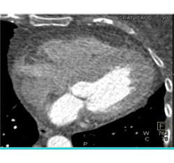 Fat in Wall of Right Ventricle - CTisus CT Scan