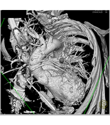 Venous Bypass Grafts and Left Internal Mammary Artery (LIMA) Graft - CTisus CT Scan