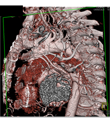 Venous Bypass Grafts and Left Internal Mammary Artery (LIMA) Graft - CTisus CT Scan