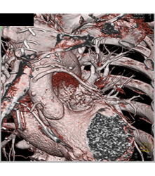 Venous Bypass Grafts and Left Internal Mammary Artery (LIMA) Graft - CTisus CT Scan