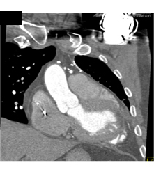 Venous Bypass Grafts and Left Internal Mammary Artery (LIMA) Graft - CTisus CT Scan