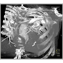 Venous Bypass Grafts and Left Internal Mammary Artery (LIMA) Graft - CTisus CT Scan