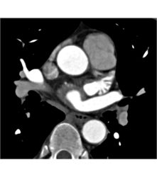 Normal Left Atrial Appendage. Note Incidental Hepatocellular Carcinoma (Hepatoma) in Cardiac CTA Patient - CTisus CT Scan