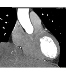 Normal Left Atrial Appendage. Note Incidental Hepatocellular Carcinoma (Hepatoma) in Cardiac CTA Patient - CTisus CT Scan