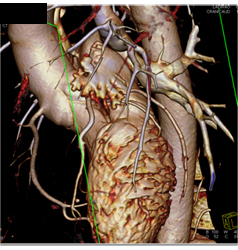 Volume Rendering and MIP of Vessels - CTisus CT Scan